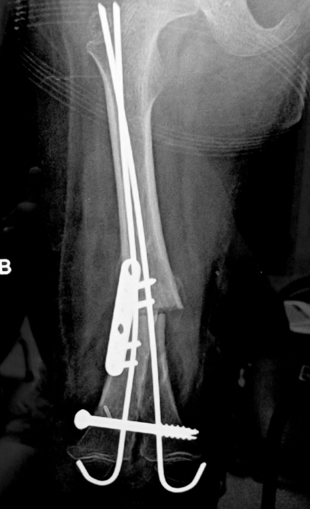 X-Ray of Amputated Right Leg