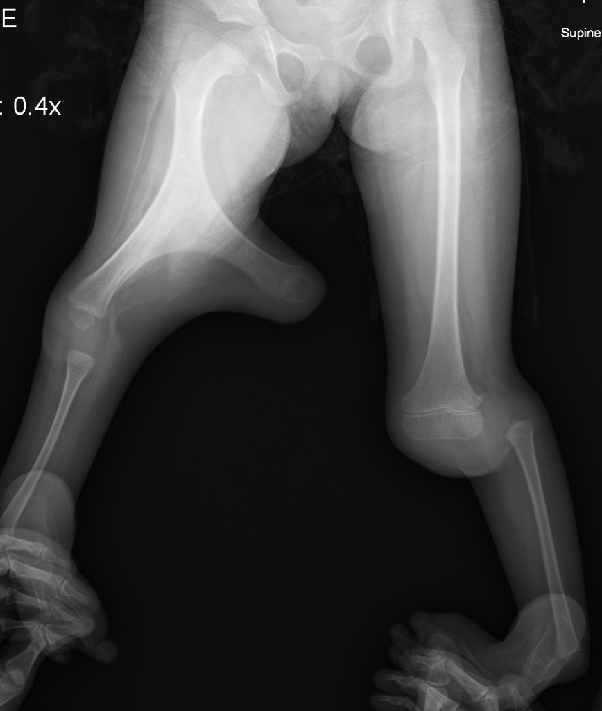 X-Ray of Bilaterial Tibial Hemimelia