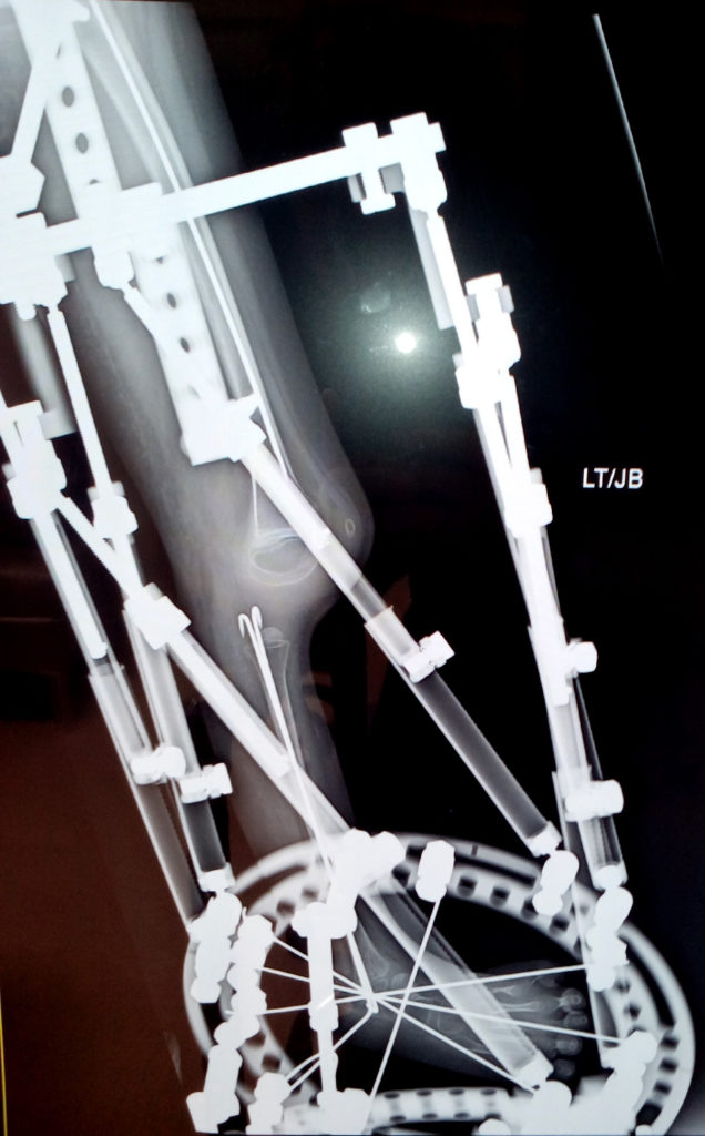 X-Ray of External Fixator on Left Leg